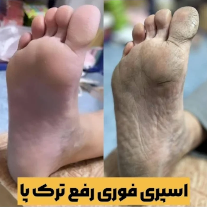 اسپری رفع ترک پا و لایه بردار راکو