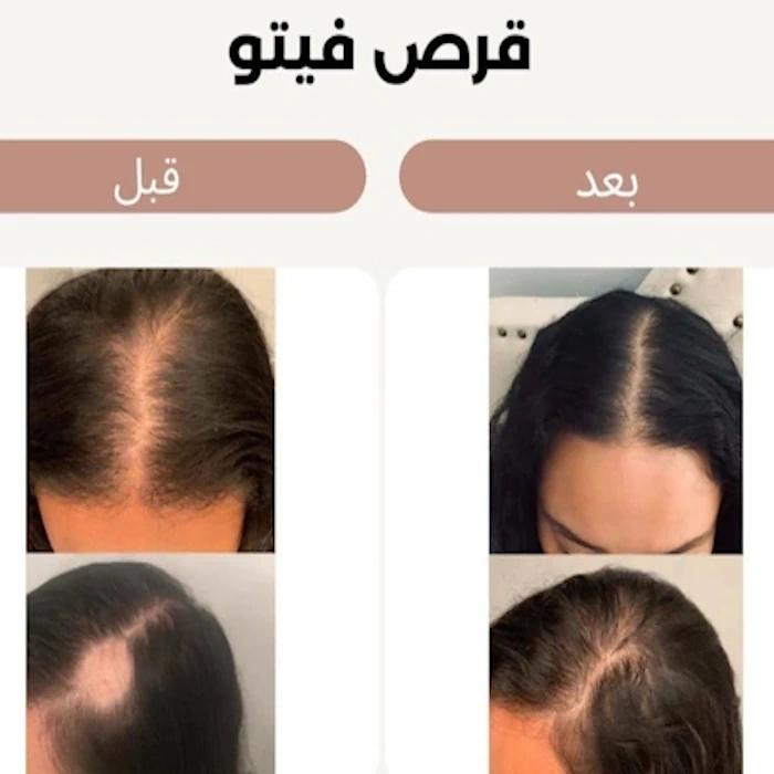 گالری تصاویر کپسول مکمل تقویت کننده مو و ناخن فیتو  فانر